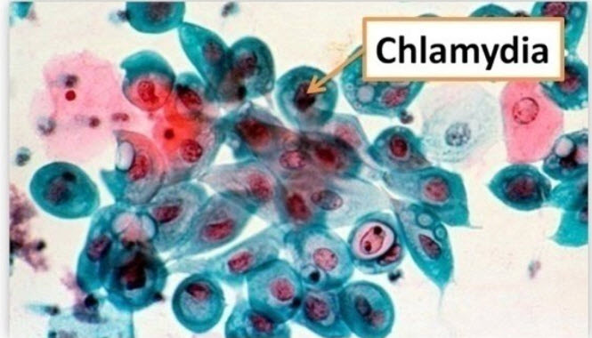 Chlamydia là một trong các bệnh lây qua đường tình dục phổ biến Chlamydia là một trong các bệnh lây qua đường tình dục phổ biến