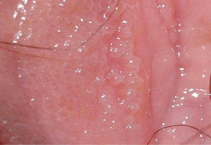 U nhú sinh dục không thể điều trị mà chỉ được cắt bỏ, đốt nóng, đốt lạnh, dùng thuốc U nhú sinh dục không thể điều trị mà chỉ được cắt bỏ, đốt nóng, đốt lạnh, dùng thuốc