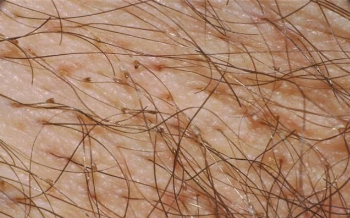 Người bị rận mu thường khiến vùng sinh dục ngứa ngáy Người bị rận mu thường khiến vùng sinh dục ngứa ngáy