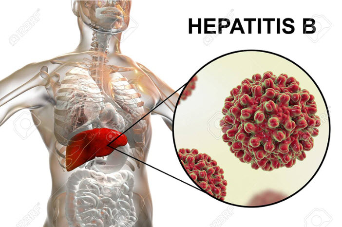 Viêm gan B không thể chữa khỏi hoàn toàn Viêm gan B không thể chữa khỏi hoàn toàn