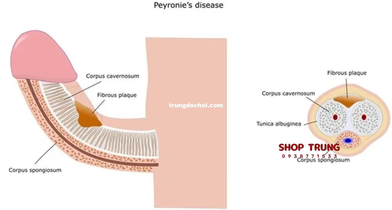 nguyen nhan duong vat bi cong nguyen nhan duong vat bi cong
