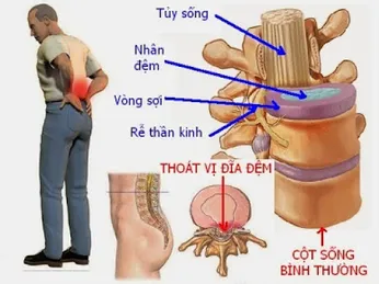 Tìm hiểu về thoát vị đĩa đệm 