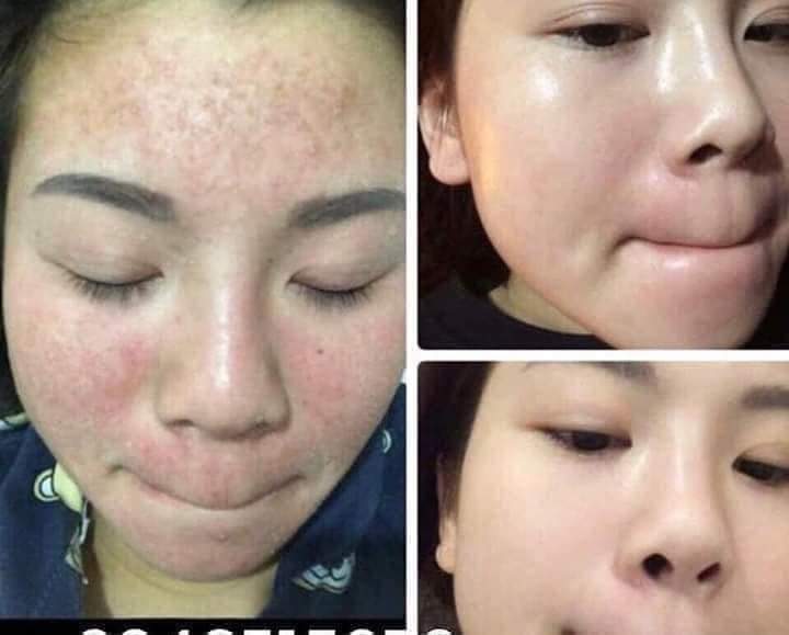 CÁC HIỆN TƯỢNG KHI SỬ DỤNG SERUM THAY DA NHÂN SÂM MQSKIN | Cần Hiểu Đúng