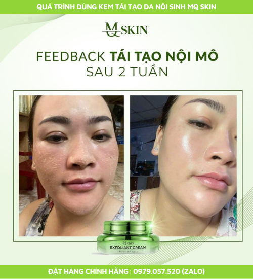 Feedback kem tái tạo da nội sinh mq skin Feedback kem tái tạo da nội sinh mq skin