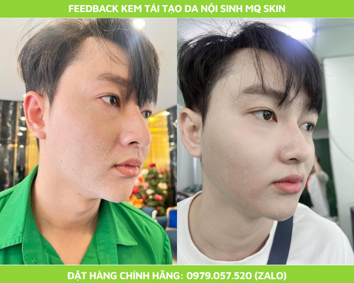 Khách dùng tái tạo nôi sinh mq skin Khách dùng tái tạo nôi sinh mq skin