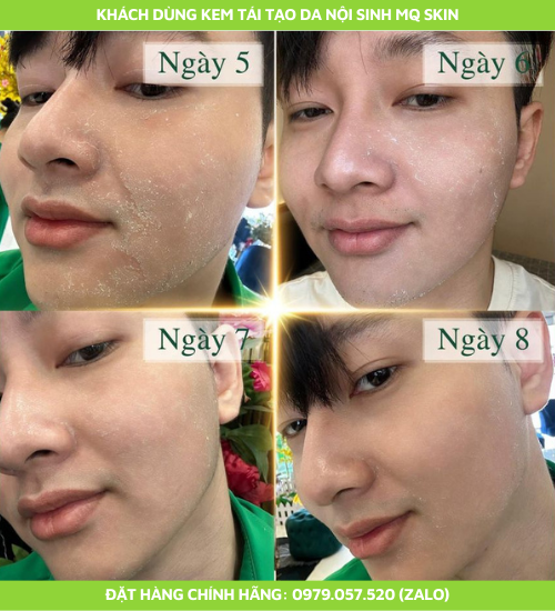 Quá trình sử dụng kem tái tạo da nội sinh mq skin Quá trình sử dụng kem tái tạo da nội sinh mq skin