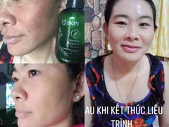 PHẢN HỒI VỀ SERUM THAY DA NHÂN SÂM MQSKIN