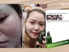 Cách giảm sưng khi tái tạo da nhân sâm mqskin