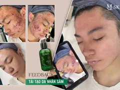 Tái Tạo Da Nhân Sâm MQ Skin Có Tốt Không ? Dùng Có Hết Mụn Nám Không ?