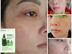 Dùng Nhân Sâm Thay Da Hàn Quốc Mấy Ngày Bong Da