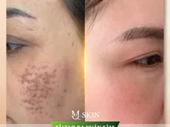 Phân loại nám và điều trị với serum thay da nhân sâm mqskin