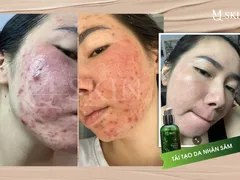 Giải thích hiện tượng sưng đỏ và cách xử lý khi dùng thay da nhân sâm mqskin
