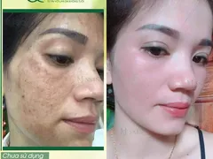 DÙNG SERUM THAY DA NHÂN SÂM MQSKIN CÓ TRỊ HẾT TÀN NHANG MỤN NÁM KHÔNG
