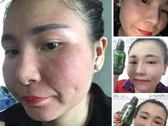 Trị Sạch Nám Bằng Serum Thay Da Nhân Sâm MQskin