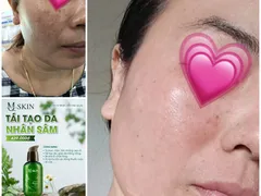 Dùng Serum Thay Da Nhân Sâm MQSkin Da Mụn Nhiều Hơn Nám Tàn Nhang Đậm Hơn ?