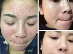 CÁC HIỆN TƯỢNG KHI SỬ DỤNG SERUM THAY DA NHÂN SÂM MQSKIN