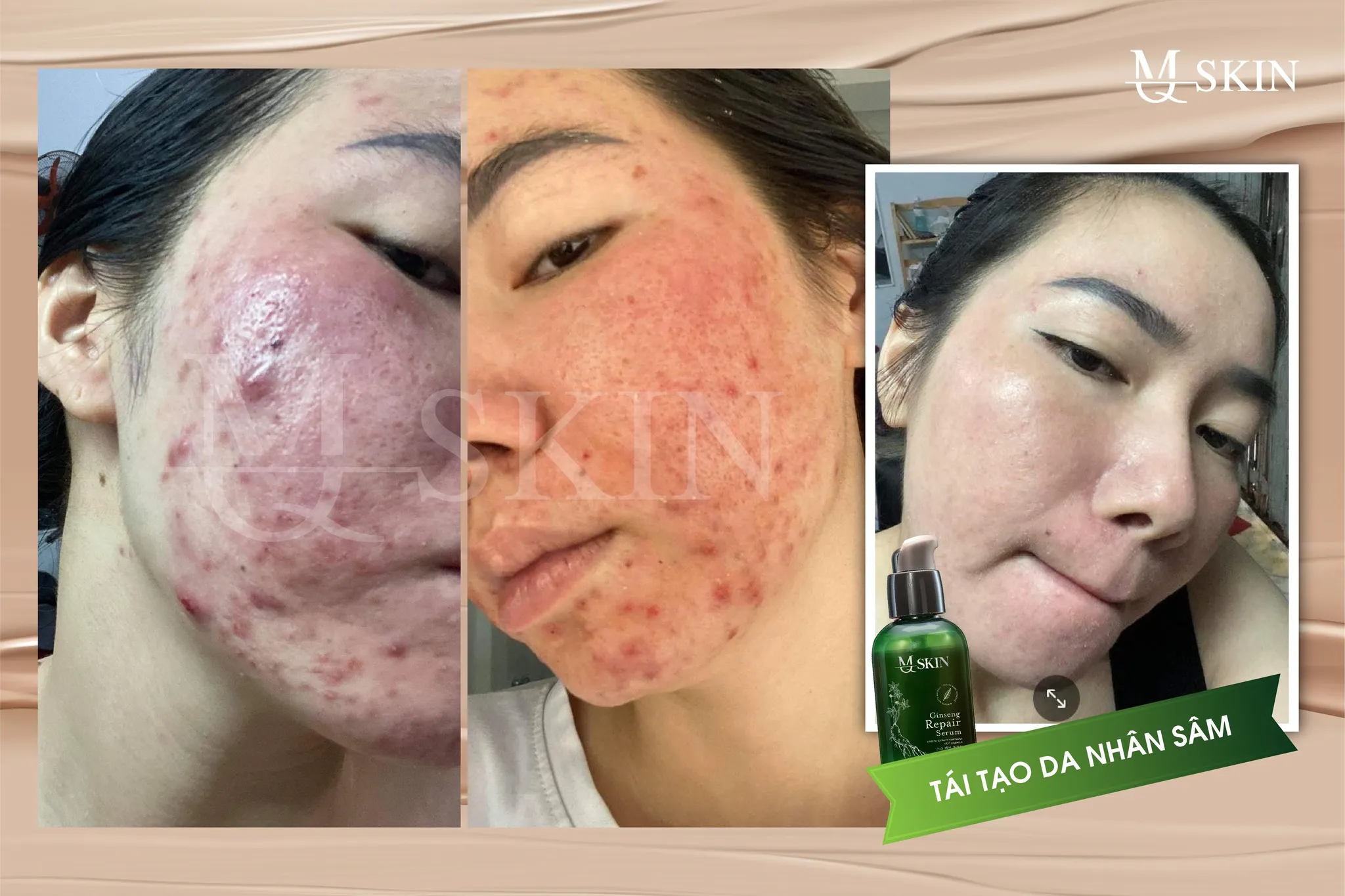 Thời gian dùng thay da nhân sâm MQ Skin để có hiệu quả nhất là bao lâu?
