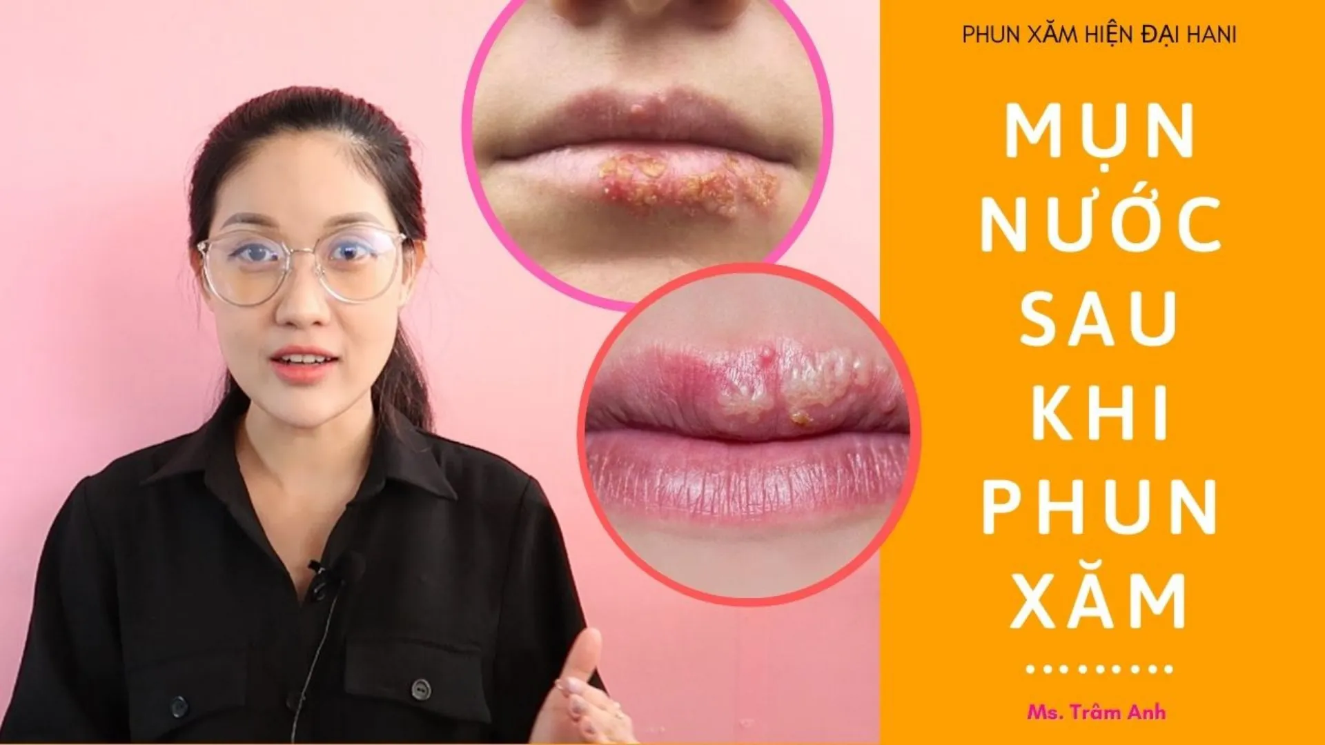 NỔI MỤN NƯỚC SAU KHI PHUN XĂM NGUYÊN NHÂN VÀ KHẮC PHỤC