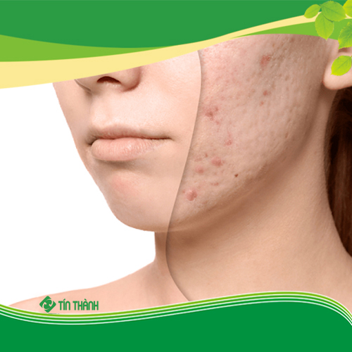 Công nghệ Laser CO2 Fractional có tốt không ? Công nghệ Laser CO2 Fractional có tốt không ?