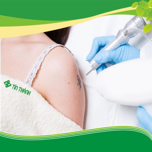 Ảnh minh họa: Hướng dẫn cách chăm sóc da sau khi xóa xăm bằng laser Ảnh minh họa: Hướng dẫn cách chăm sóc da sau khi xóa xăm bằng laser