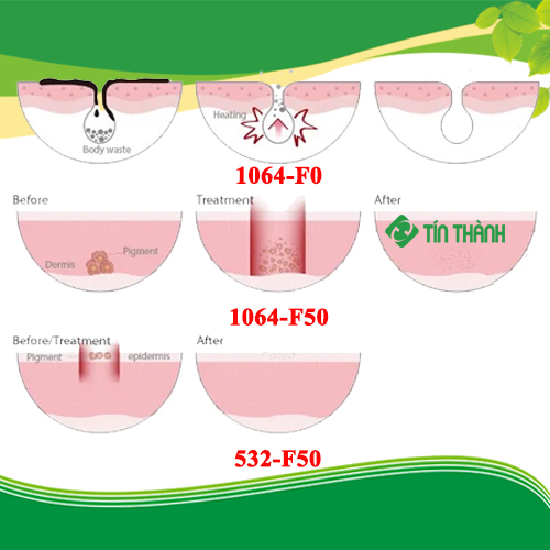 Máy laser RUIKD giá bao nhiêu, ưu điểm và lưu ý khi sử dụng máy Máy laser RUIKD giá bao nhiêu, ưu điểm và lưu ý khi sử dụng máy