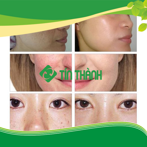 Công nghệ Picosecond laser là gì ? Công nghệ Picosecond laser là gì ?