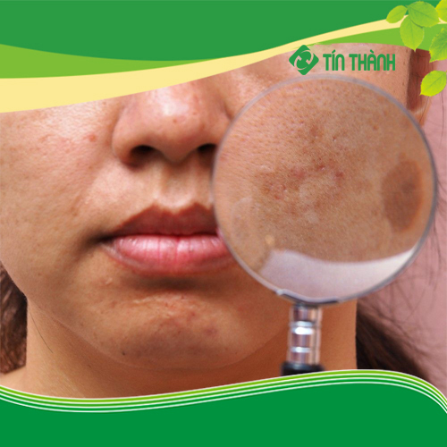 Máy laser Picotech giá bao nhiêu và công dụng thế nào ? Máy laser Picotech giá bao nhiêu và công dụng thế nào ?