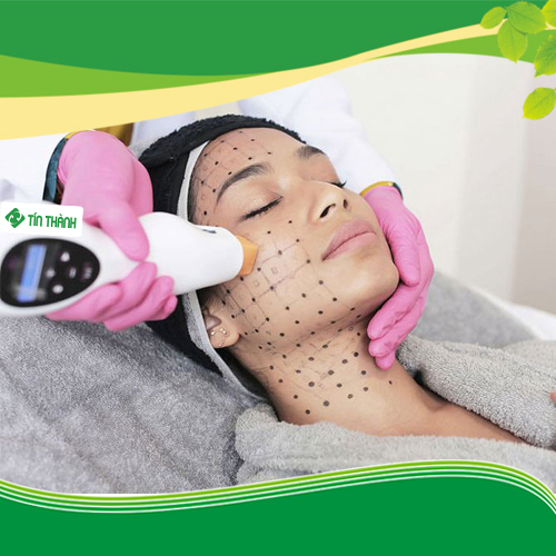 Kết quả nâng cơ bằng Thermage FLX giữ được bao lâu ? Kết quả nâng cơ bằng Thermage FLX giữ được bao lâu ?