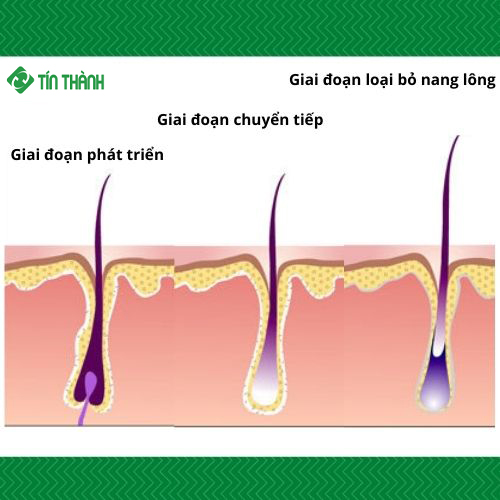 Triệt lông bằng laser có hiệu quả không Triệt lông bằng laser có hiệu quả không