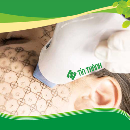 Tác dụng của Thermage Tác dụng của Thermage