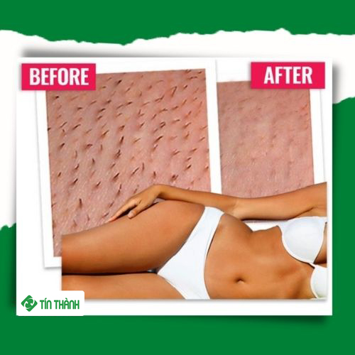 Liệu trình triệt lông vĩnh viễn mà bạn cần biết Liệu trình triệt lông vĩnh viễn mà bạn cần biết