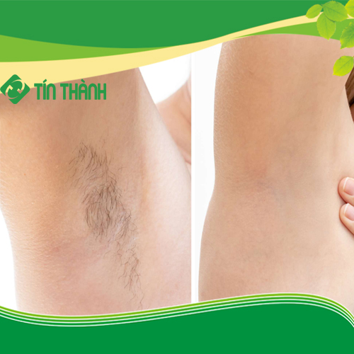 Bị ngứa sau khi triệt lông vĩnh viễn và giải pháp Bị ngứa sau khi triệt lông vĩnh viễn và giải pháp