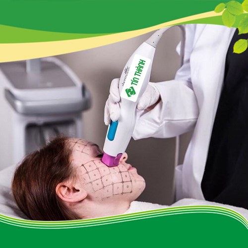 Phương pháp nâng cơ mặt bằng Thermage mới nhất hiện nay Phương pháp nâng cơ mặt bằng Thermage mới nhất hiện nay