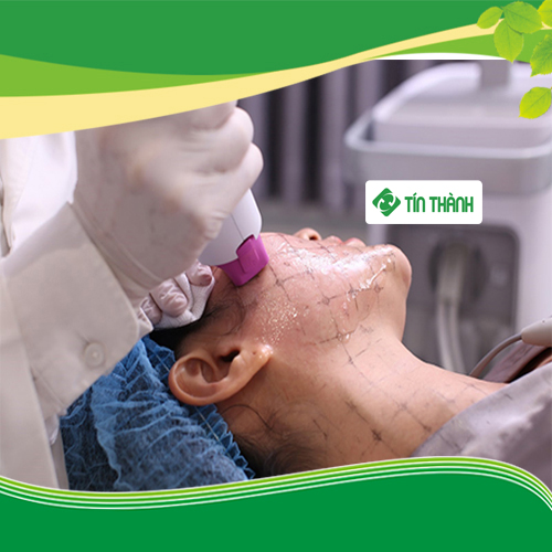 Trẻ hóa da bằng công nghệ Thermage Trẻ hóa da bằng công nghệ Thermage