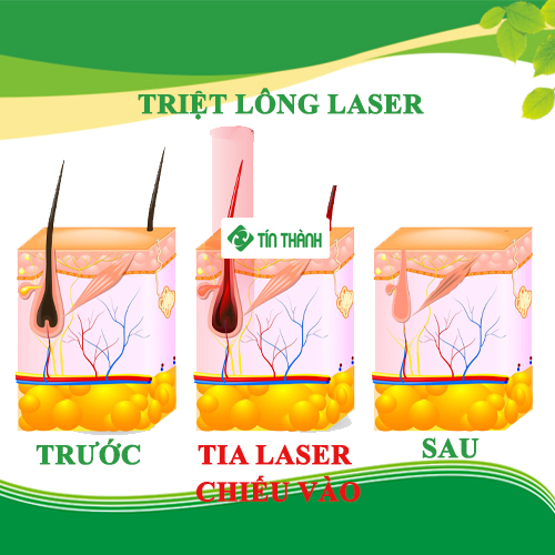 Triệt lông nách giá bao nhiêu Triệt lông nách giá bao nhiêu