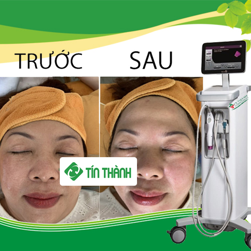 Hình ảnh trước và sau điều trị Thermage do Tín Thành thực hiện Hình ảnh trước và sau điều trị Thermage do Tín Thành thực hiện