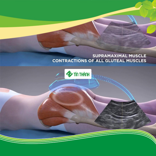 Review máy giảm mỡ bụng Emsculpt Review máy giảm mỡ bụng Emsculpt