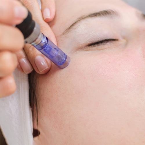 Những điều cần biết về công nghệ lăn kim trị sẹo Những điều cần biết về công nghệ lăn kim trị sẹo