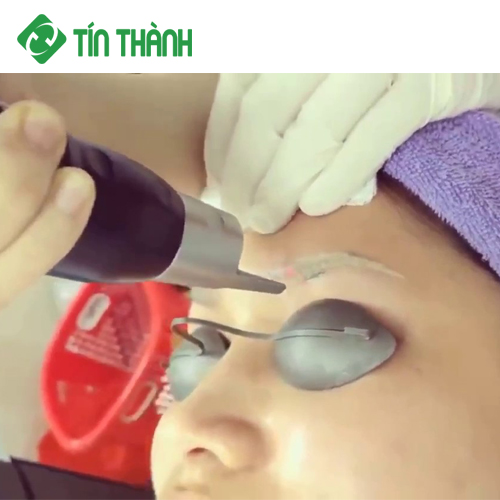 Xóa xăm lông mày Picosure rất an toàn Xóa xăm lông mày Picosure rất an toàn