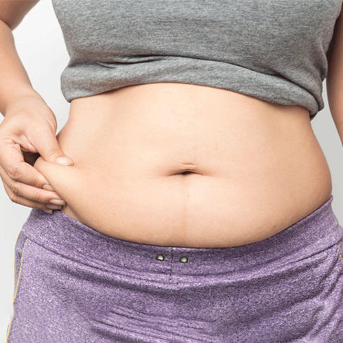 Mỡ tích tụ vùng eo Mỡ tích tụ vùng eo