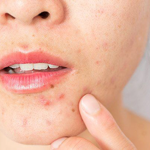 Cách trị mụn bằng kem đánh răng có hiệu quả không ? Cách trị mụn bằng kem đánh răng có hiệu quả không ?