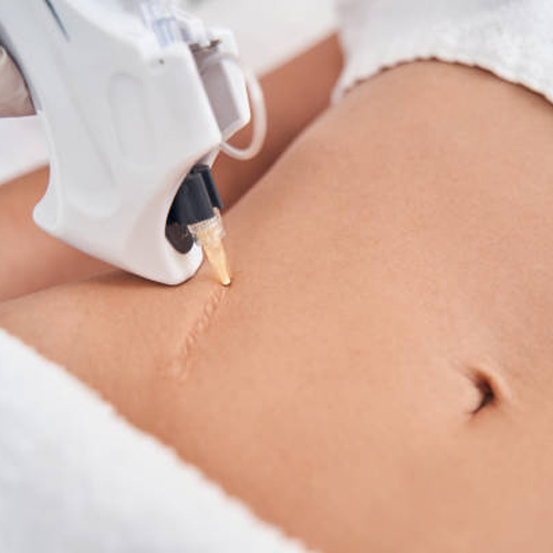 Cách xóa sẹo lâu năm hiệu quả nhất Cách xóa sẹo lâu năm hiệu quả nhất