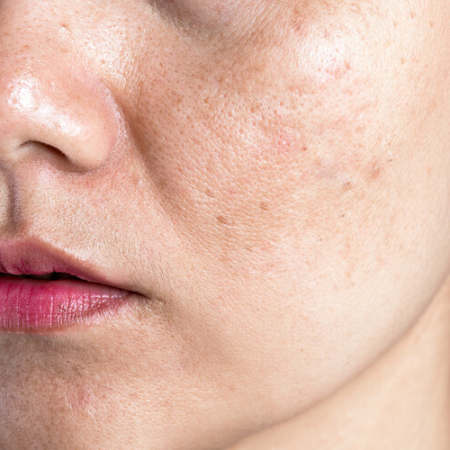 Tìm hiểu về nám da và cách chăm sóc da nám Tìm hiểu về nám da và cách chăm sóc da nám