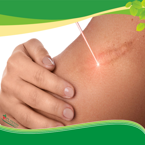 Các bước chăm sóc da sau khi bắn Laser CO2 Fractional hiệu quả Các bước chăm sóc da sau khi bắn Laser CO2 Fractional hiệu quả