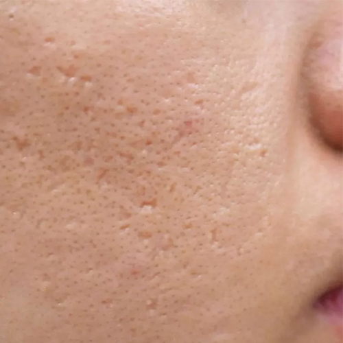 Công nghệ trị sẹo rỗ mới nhất hiệu quả nhất hiện nay Công nghệ trị sẹo rỗ mới nhất hiệu quả nhất hiện nay