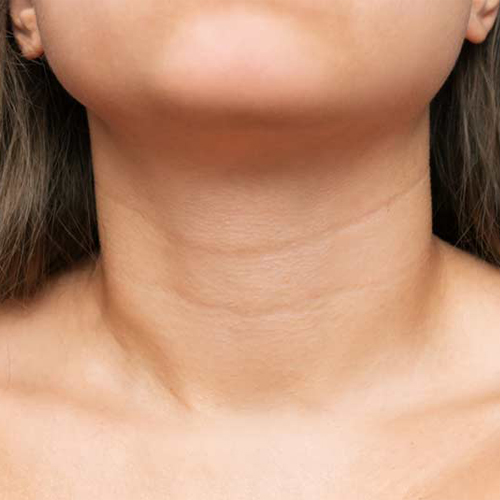 Nguyên nhân và cách điều trị da cổ bị nhăn Nguyên nhân và cách điều trị da cổ bị nhăn