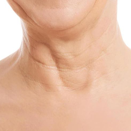 Nguyên nhân và cách điều trị da cổ bị nhăn Nguyên nhân và cách điều trị da cổ bị nhăn