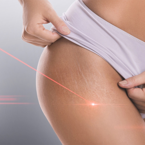 Điều trị rạn da bằng laser là gì và hiệu quả thế nào? Điều trị rạn da bằng laser là gì và hiệu quả thế nào?