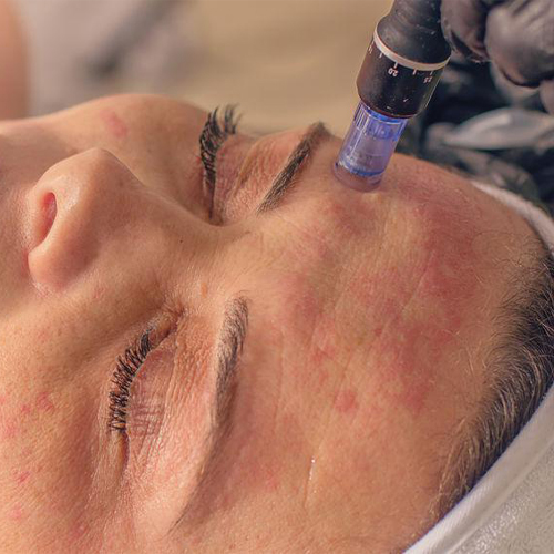 Dụng cụ lăn kim trị mụn có tốt không? Dụng cụ lăn kim trị mụn có tốt không?