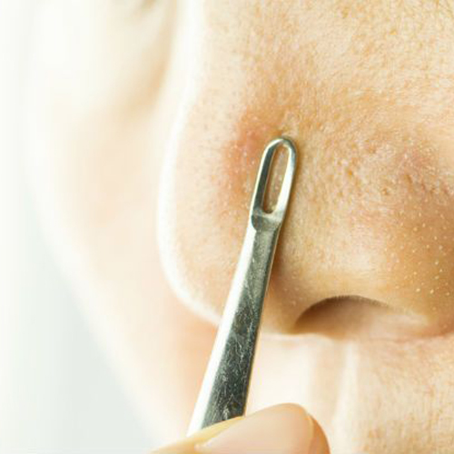 Dụng cụ nặn mụn là gì và mẹo lấy mụn đơn giản tại nhà Dụng cụ nặn mụn là gì và mẹo lấy mụn đơn giản tại nhà